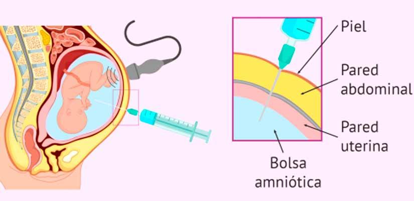 Amniocentesis Actuamed 6599